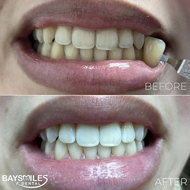 BaySmiles Dental | Dental Sealants, Dental Fillings and Dental Cleanings