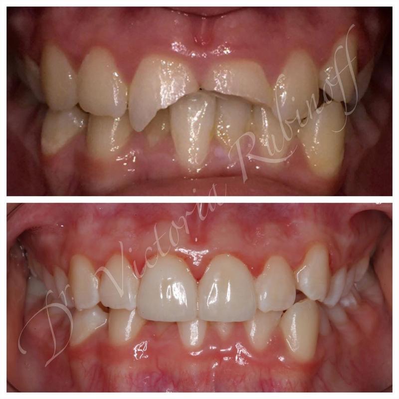 BaySmiles Dental | Extractions, All-on-6 reg  and Implant Dentistry