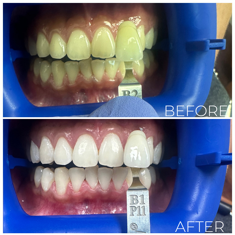 BaySmiles Dental | Preventative Program, Dental Fillings and Dental Cleanings