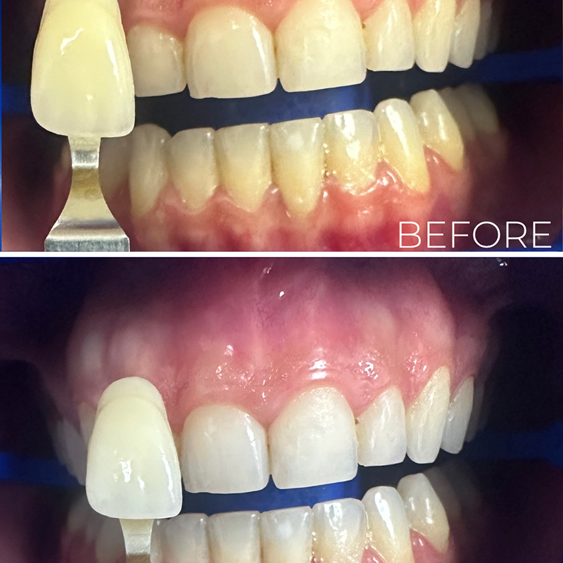 BaySmiles Dental | Root Canals, Full Mouth Reconstruction and All-on-4 reg 