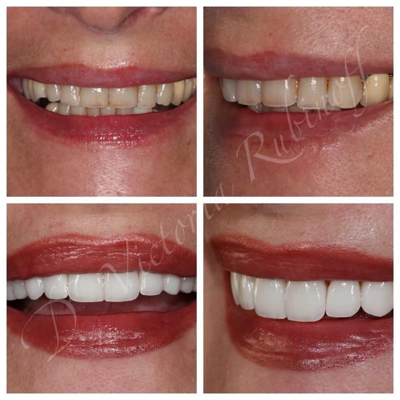 BaySmiles Dental | Dental Fillings, Dental Sealants and Extractions