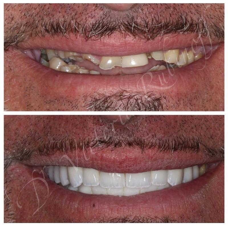 BaySmiles Dental | All-on-4 reg , Root Canals and Implant Dentistry