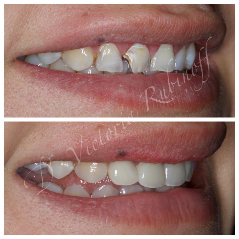 BaySmiles Dental | Implant Restorations, Dental Bridges and Dental Fillings