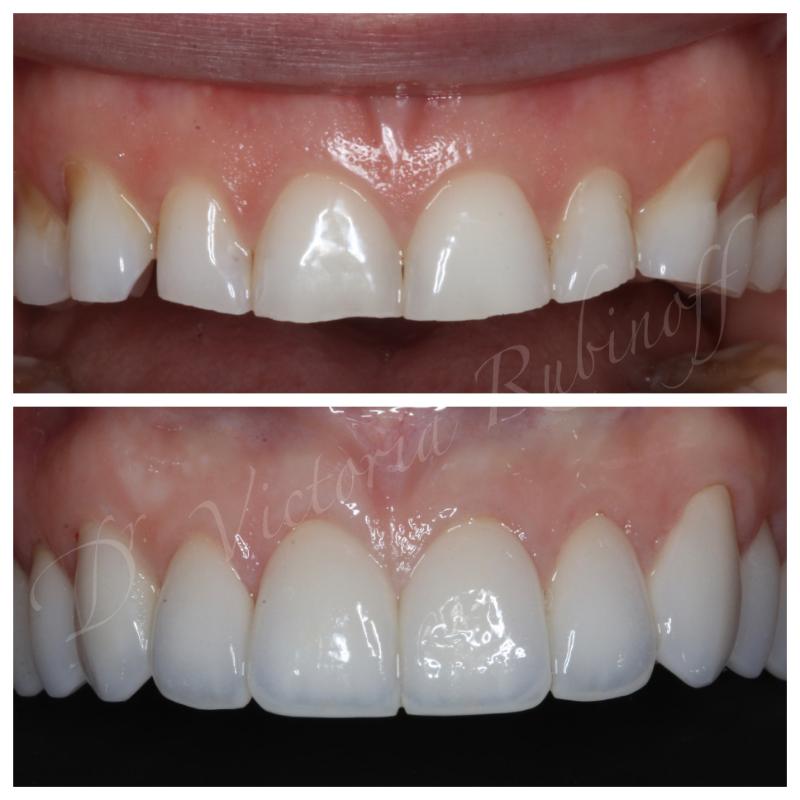 BaySmiles Dental | Implant Dentistry, Dental Bridges and All-on-4 reg 