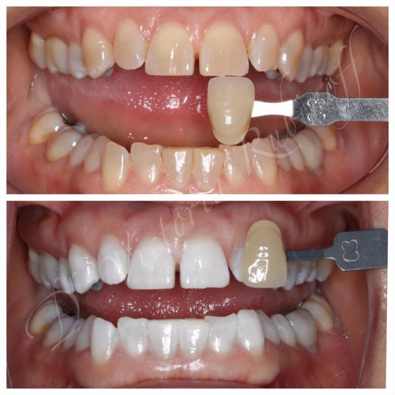 BaySmiles Dental | Inlays  amp  Onlays, Periodontal Treatment and Oral Exams