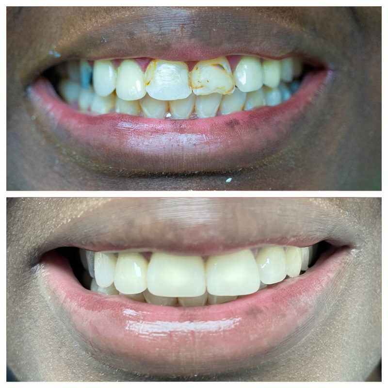 BaySmiles Dental | Teeth Whitening, Periodontal Treatment and Invisalign reg 