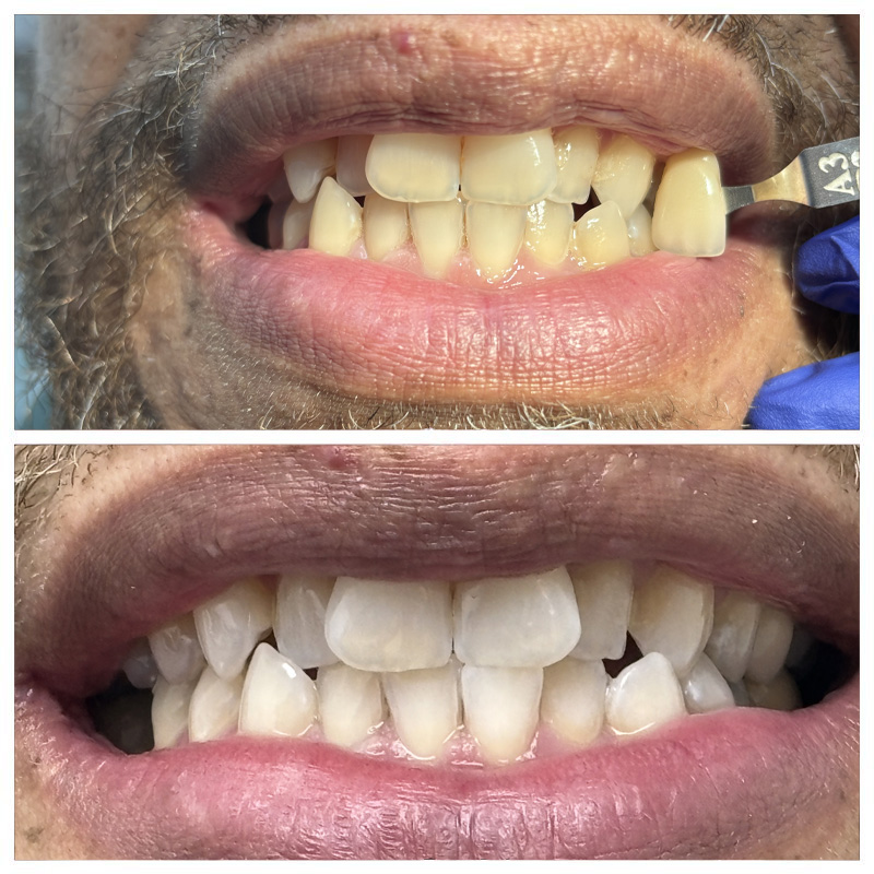 BaySmiles Dental | Inlays  amp  Onlays, Dental Cleanings and Periodontal Treatment