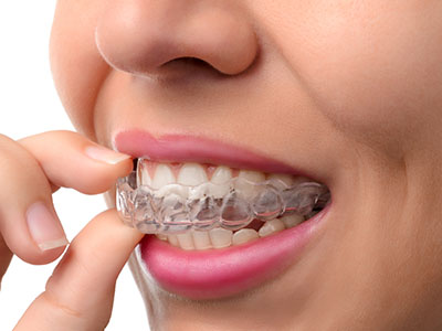 Smiling woman with clear braces, adjusting her teeth alignment.